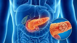 Illustrazione del pancreas umano con evidenziamento di una massa tumorale